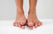 How to Get Rid van voet jeuk tussen de tenen