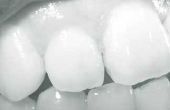 De gemiddelde kosten van fineren voor tanden