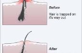 How to Get Rid van een geïnfecteerde ingegroeide haren