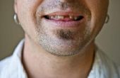 De gemiddelde kosten van tandheelkundige implantaten in Canada