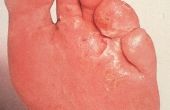 Hoe te behandelen voet schimmel met een borrelende voetbad