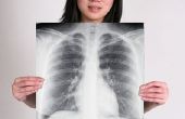 Tekenen & symptomen van humaan papillomavirus in de longen