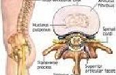 Lumbale Spinale stenose symptomen