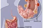 Hoe natuurlijk behandelen Diverticulitis symptomen