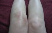 Wat kan ernstige pijn in knie & zwelling veroorzaken?