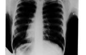 Beperkingen van conventionele radiografie