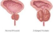 Bijwerkingen van laserbehandeling van de prostaat