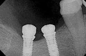 Tekenen van infectie Dental Implant