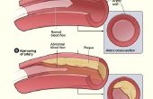 Geblokkeerde slagader symptomen & bloedvaten