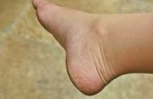 Hoe te verwijderen van de harde huid van de voeten