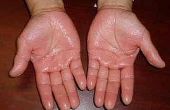 Hoe te genezen van zweterige handen