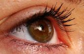How to Lose oog zakken