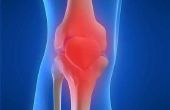 Wat zijn de behandelingen voor artrose in de knie?