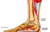 How to Cure Achilles tendinitis