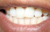 Profs & tegens van tandheelkundige verzekering