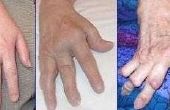 Symptomen van artritis in de handen