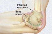 Behandeling van elleboog Bone Spurs