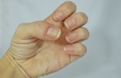 Hoe om te genezen en te voorkomen dat gebarsten huid rond de nagels