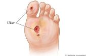 Wat doet een voet Ulcus Look Like?