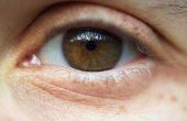 Wat zijn de oorzaken van verkleuring van het ooglid?