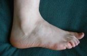 De beste behandeling voor perifere neuropathie in voeten