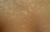 How to Get Rid van Tinea Versicolor (Pityriasis Versicolor) aandoening van de huid