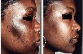 Afro-Amerikaanse huidaandoeningen