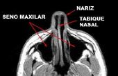 Over ziekte van de maxillaire Sinus