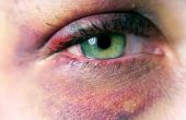 Hoe te behandelen van een Black Eye (bloeduitstorting)