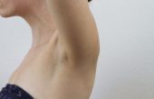 How to Get Rid van onderarm hobbels