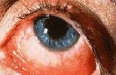 Chlamydia oog infectie symptomen
