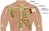 Symptomen van een peesontsteking in de schouder