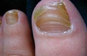 Een nagel schimmel behandeling met Vicks