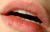 Lip Herpes-symptomen
