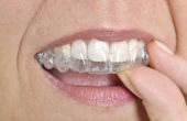 Hoe om te achterhalen welke tandheelkundige verzekering dekt Invisalign