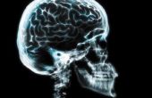 Bijwerkingen van een hersenschudding
