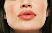 Welke oorzaken droge huid rond de mond?