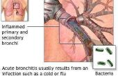 Symptomen van Bronchitis in peuters