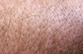How to Get mijten off van menselijke huid