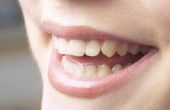 How to Fix van gevoelige tanden