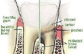 Hoe te genezen van parodontale aandoeningen
