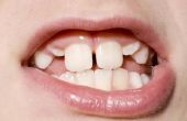 Opties voor positiebepaling vol tanden