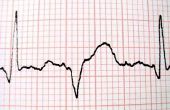 Hoe de berekening van de hartslag op een EKG