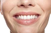Hoe te kwalificeren voor gratis tandheelkundige behandelingen