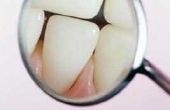Hoe te verwijderen van verharde tandplak tussen de tanden