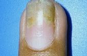 Hoe de behandeling van Psoriasis van de nagels