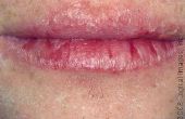 Wat oorzaken gebarsten lippen splitsen?