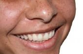 How to Get witte tanden snel