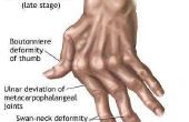 Stadia van reumatoïde artritis
