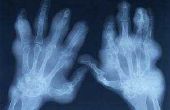 Artritis symptomen in de vingers